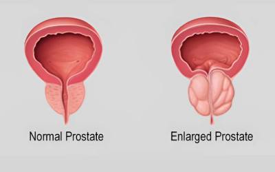 Prostate Enlargement Treatment